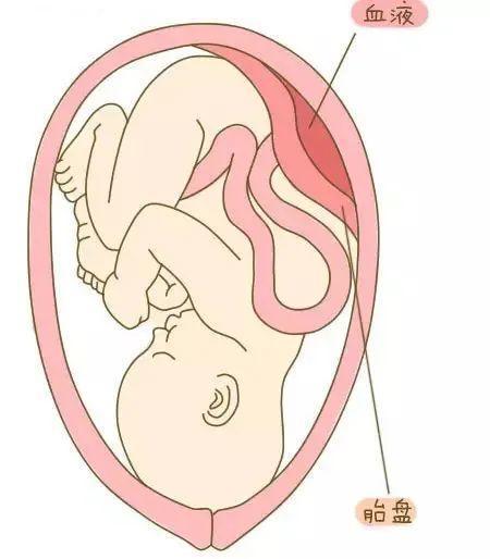 孕32周产妇突发胎盘早剥，莲池争分夺秒保姆婴平安